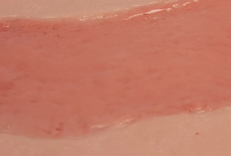 Wundmoulage Ulcus Cruris Arteriosum (Epithelisierungsphase) gross