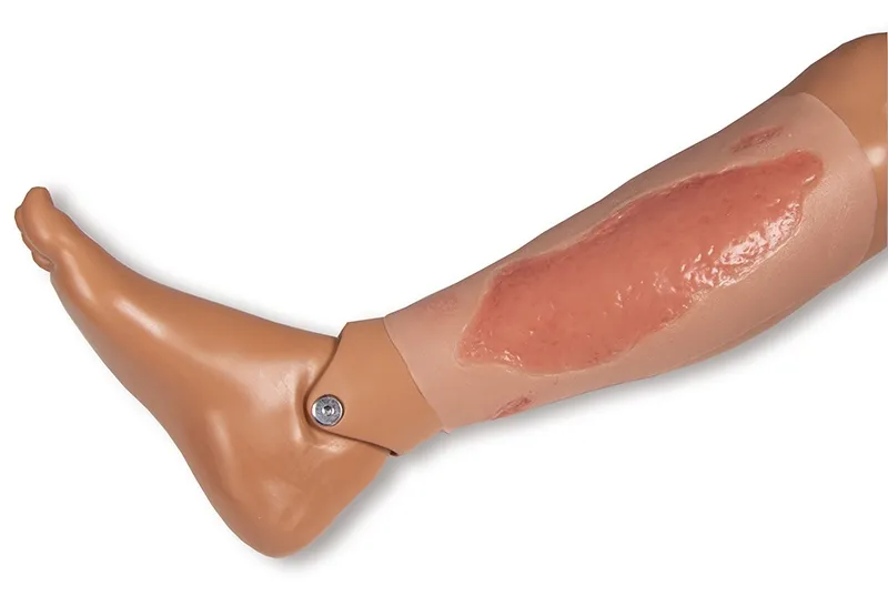 Wundmoulage Ulcus Cruris Arteriosum (Epithelisierungsphase) gross