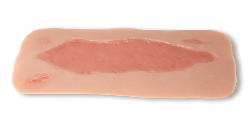 Wundmoulage Ulcus Cruris Arteriosum (Epithelisierungsphase) gross