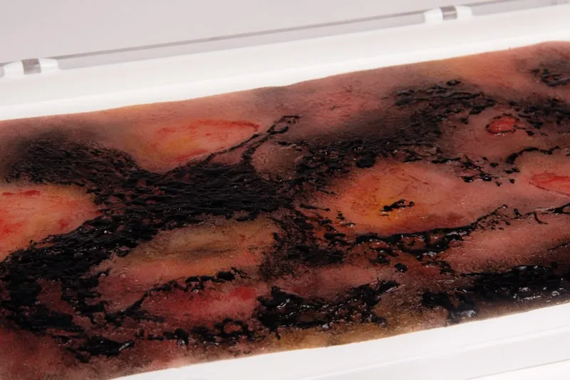 Wundmoulage Verbrennung III. Grades