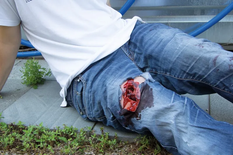 Wundmoulage wound packing