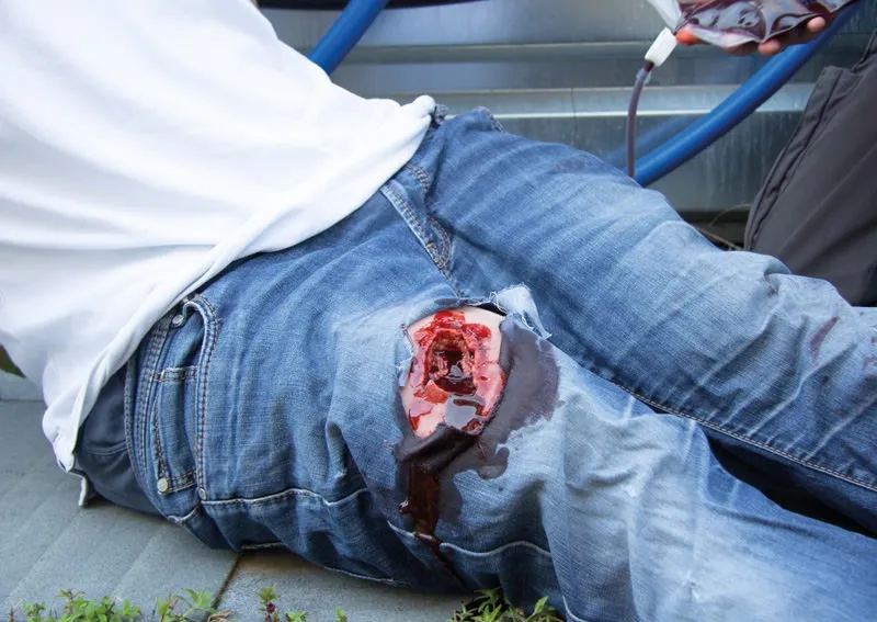 Wundmoulage wound packing