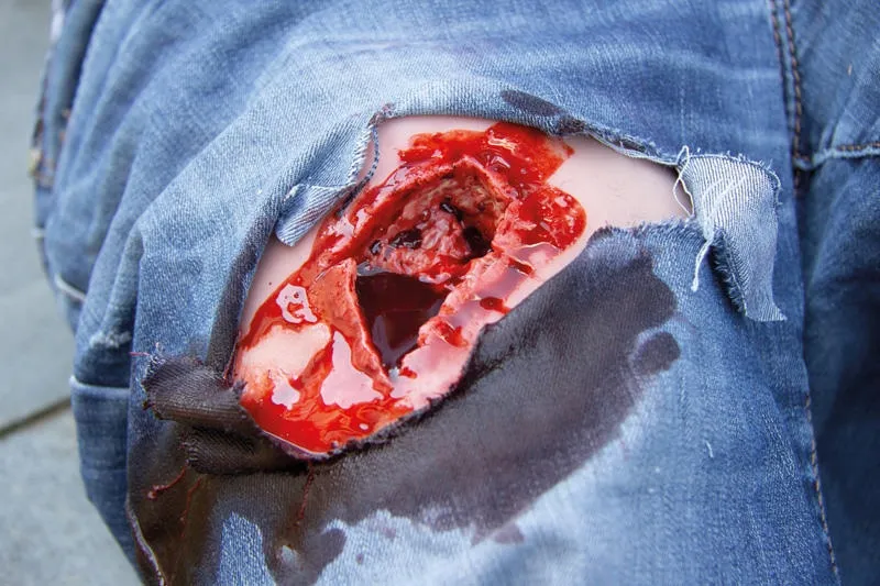 Wundmoulage wound packing