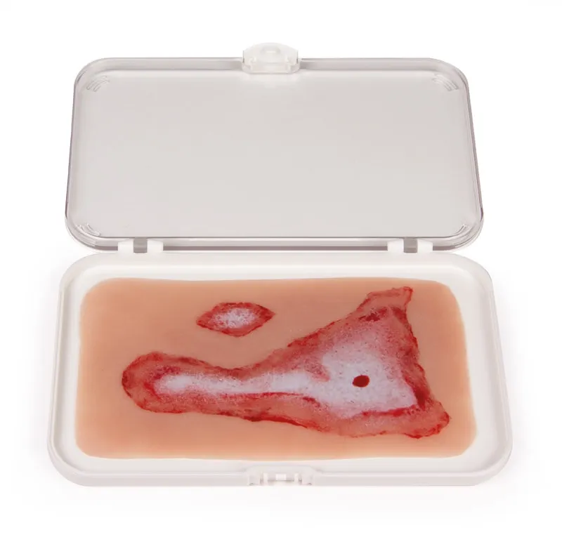 Wundmoulage Verbrühung