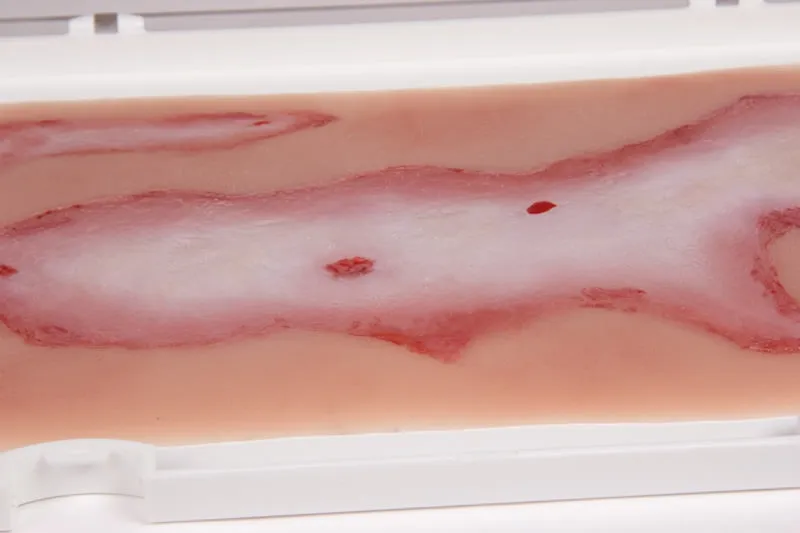 Wundmoulage Verbrühung