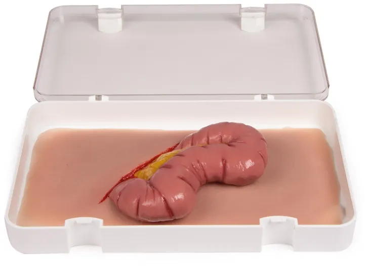 Wundmoulage Dickdarmaustritt