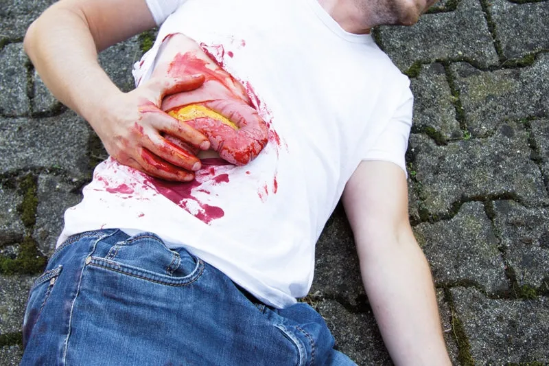 Wundmoulage Dickdarmaustritt
