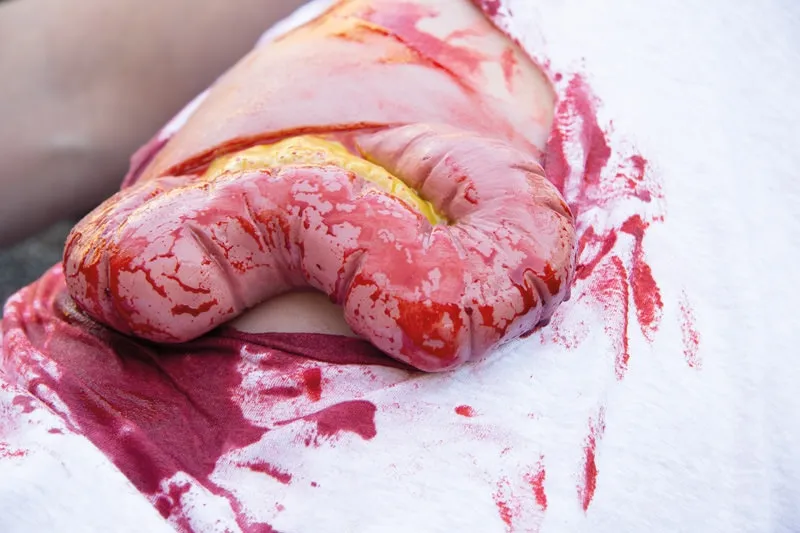 Wundmoulage Dickdarmaustritt