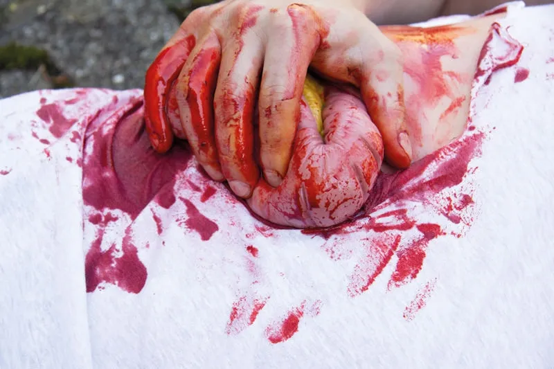 Wundmoulage Dickdarmaustritt
