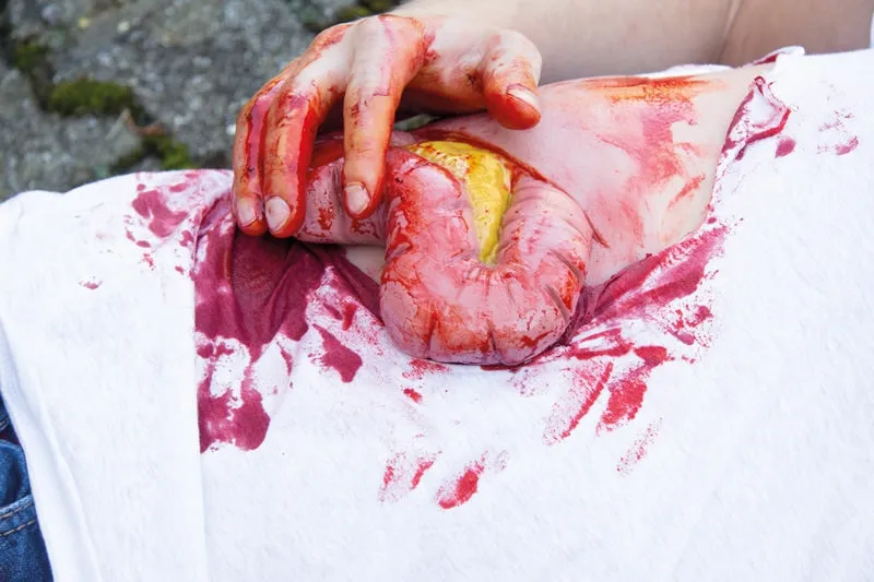 Wundmoulage Dickdarmaustritt