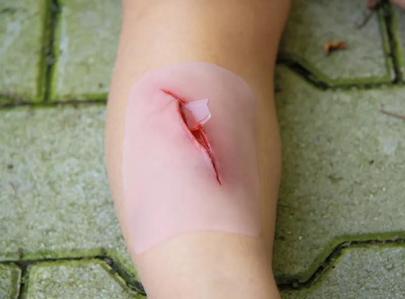 Wundmoulage Schnittwunde mit Glassplitter
