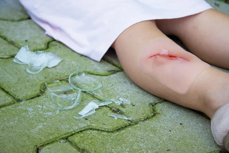 Wundmoulage Schnittwunde mit Glassplitter