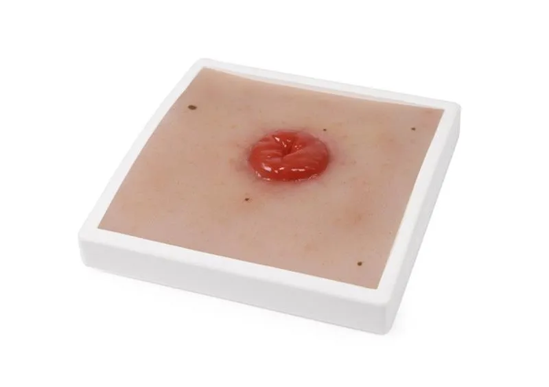 Wundmoulage Kolostoma, inkl. Stativ