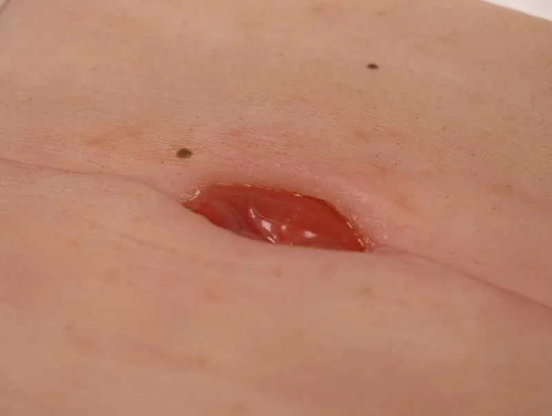 Wundmoulage Kolostoma in Bauchfalte, inkl. Stativ
