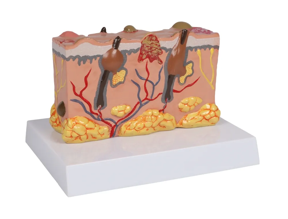 Pathologisches Hautmodel