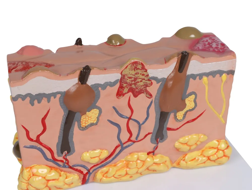 Pathologisches Hautmodel