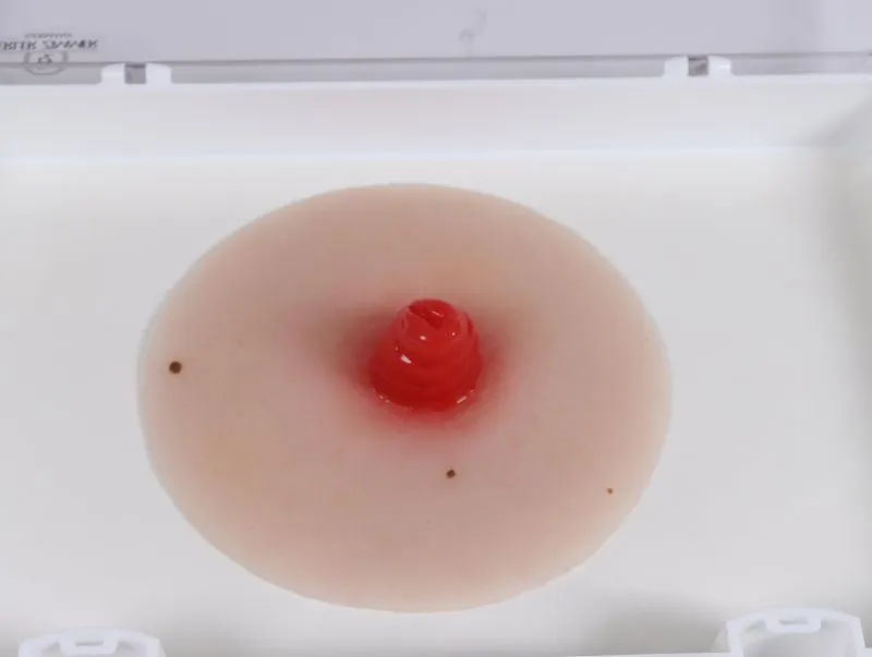 Wundmoulage Ileostoma, selbsthaftend