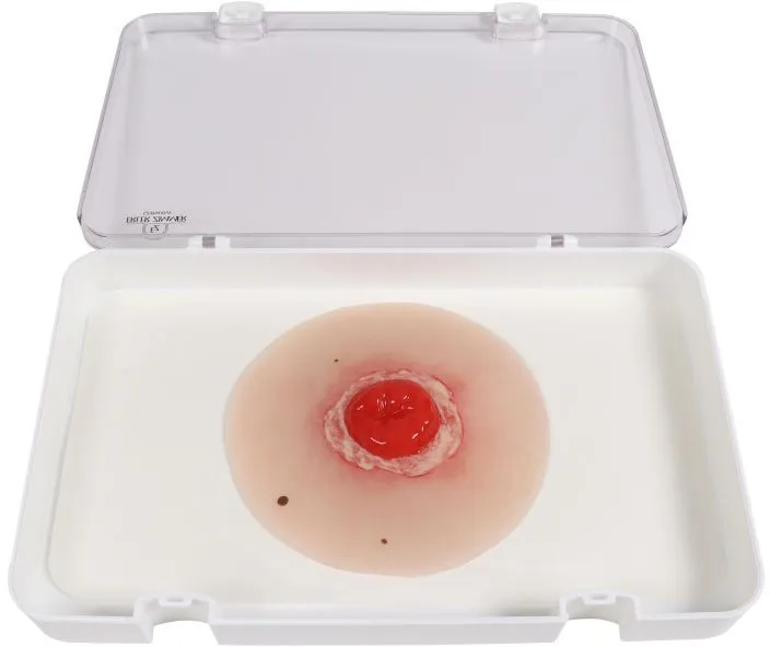 Wundmoulage Kolostoma entzündet, selbsthaftend