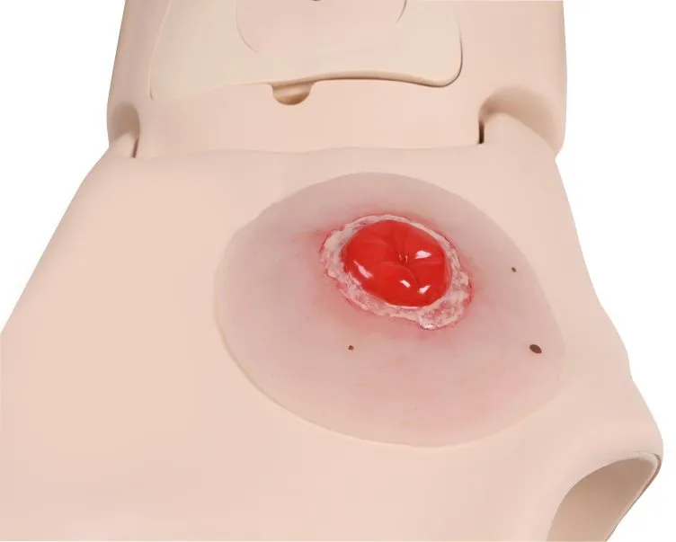 Wundmoulage Kolostoma entzündet, selbsthaftend