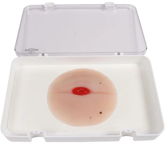 Wundmoulage Kolostoma in Bauchfalte, selbsthaftend
