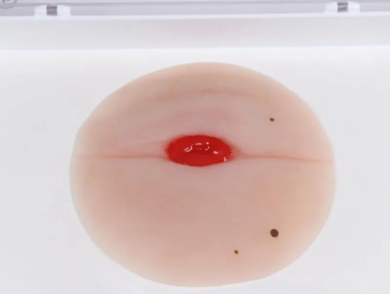Wundmoulage Kolostoma in Bauchfalte, selbsthaftend