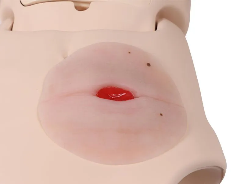 Wundmoulage Kolostoma in Bauchfalte, selbsthaftend