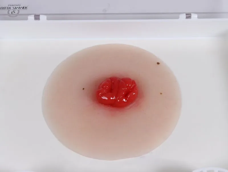 Wundmoulage Kolostoma doppelläufig, selbsthaftend