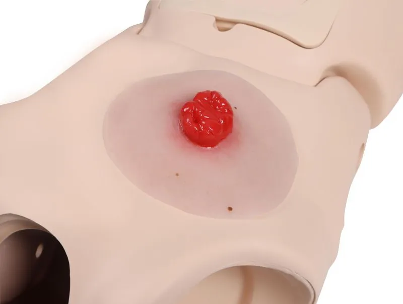 Wundmoulage Kolostoma doppelläufig, selbsthaftend