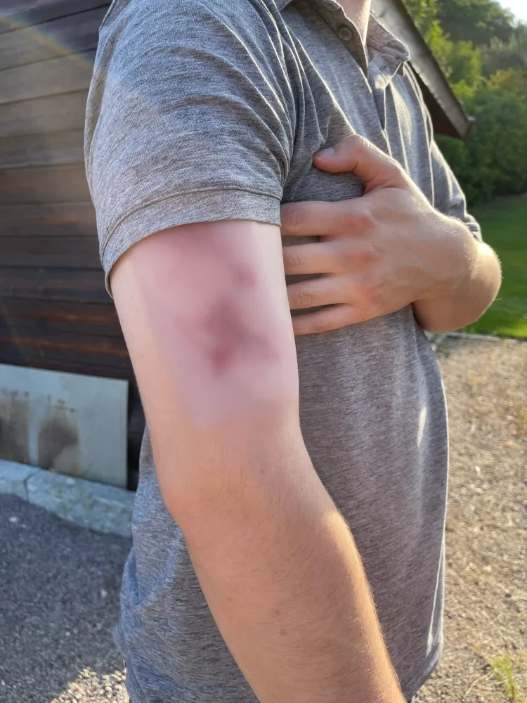 Wundmoulage Hämatom frisch
