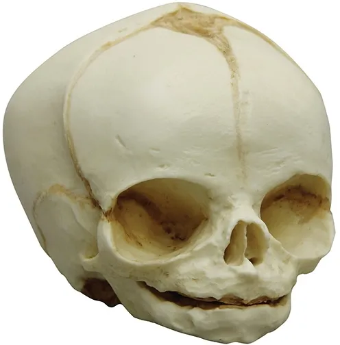 Fetusschädel, 31 Wochen