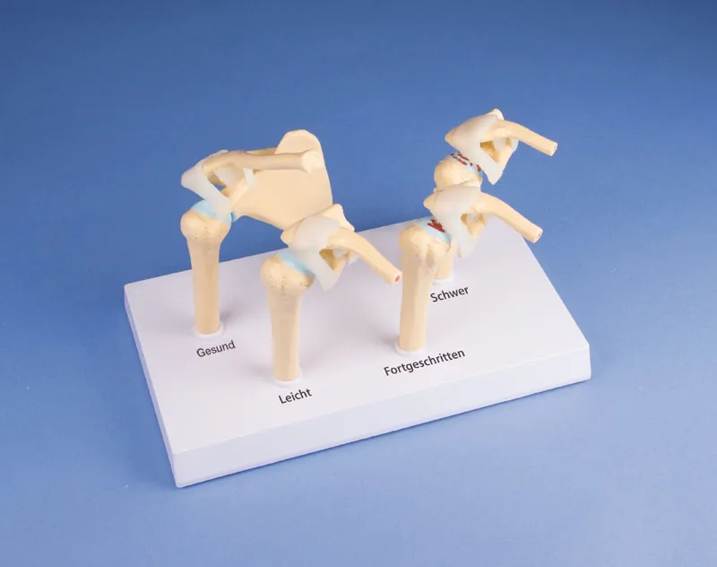 4-Stadien-Osteoarthritis Schulter