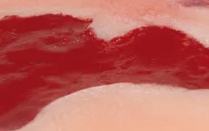 Wundmoulage Ulcus Cruris Arteriosum (Granulationsphase) klein
