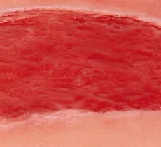 Wundmoulage Ulcus Cruris Arteriosum (Granulationsphase) gross