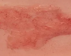 Wundmoulage Ulcus Cruris Arteriosum (Epithelisierungsphase) klein