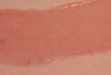 Wundmoulage Ulcus Cruris Arteriosum (Epithelisierungsphase) gross