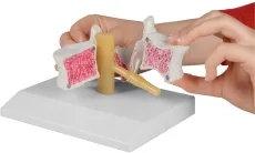 Osteoporose-Wirbel, 2-fach vergrössert