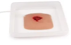 Wundmoulage wound packing
