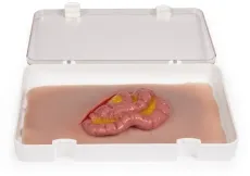 Wundmoulage Dünndarmaustritt
