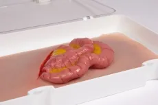 Wundmoulage Dünndarmaustritt