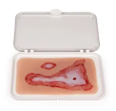 Wundmoulage Verbrühung