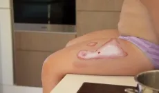 Wundmoulage Verbrühung