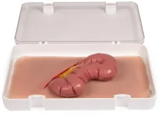 Wundmoulage Dickdarmaustritt