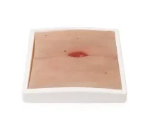 Wundmoulage Kolostoma in Bauchfalte, inkl. Stativ