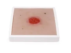 Wundmoulage Kolostoma unter Hautniveau, inkl. Stativ