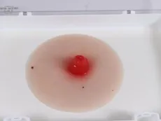 Wundmoulage Ileostoma, selbsthaftend