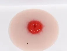 Wundmoulage Kolostoma, selbsthaftend