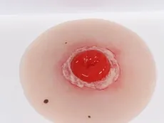 Wundmoulage Kolostoma entzündet, selbsthaftend