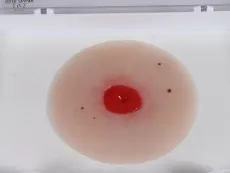 Wundmoulage Kolostoma unter Hautniveau, selbsthaftend