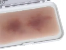 Wundmoulage Hämatom älter