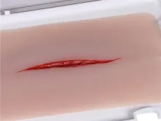 Wundmoulage Halsschnitt